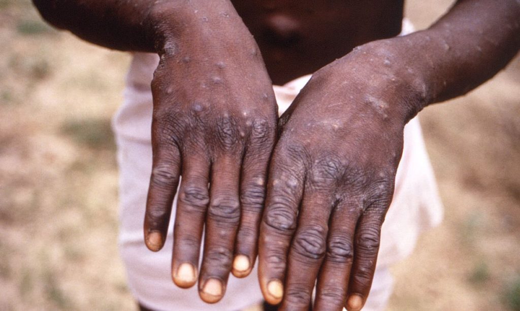 Casos suspeitos de monkeypox são descartados em SC